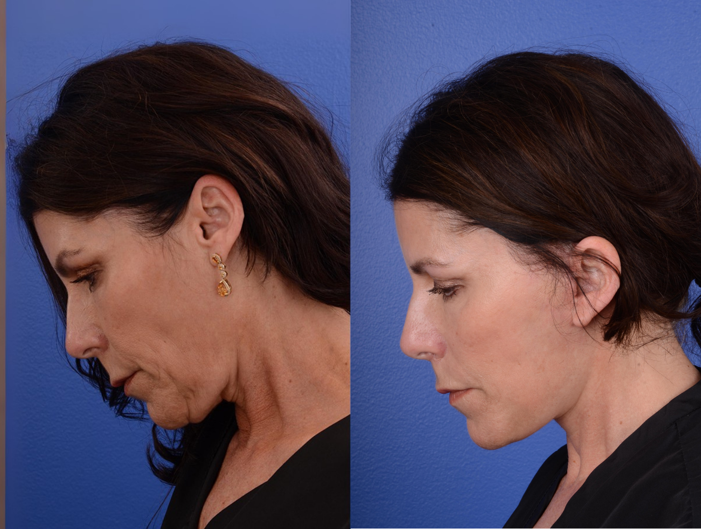 Facelift Before & After Gallery - Patient 261613 - Image 3
