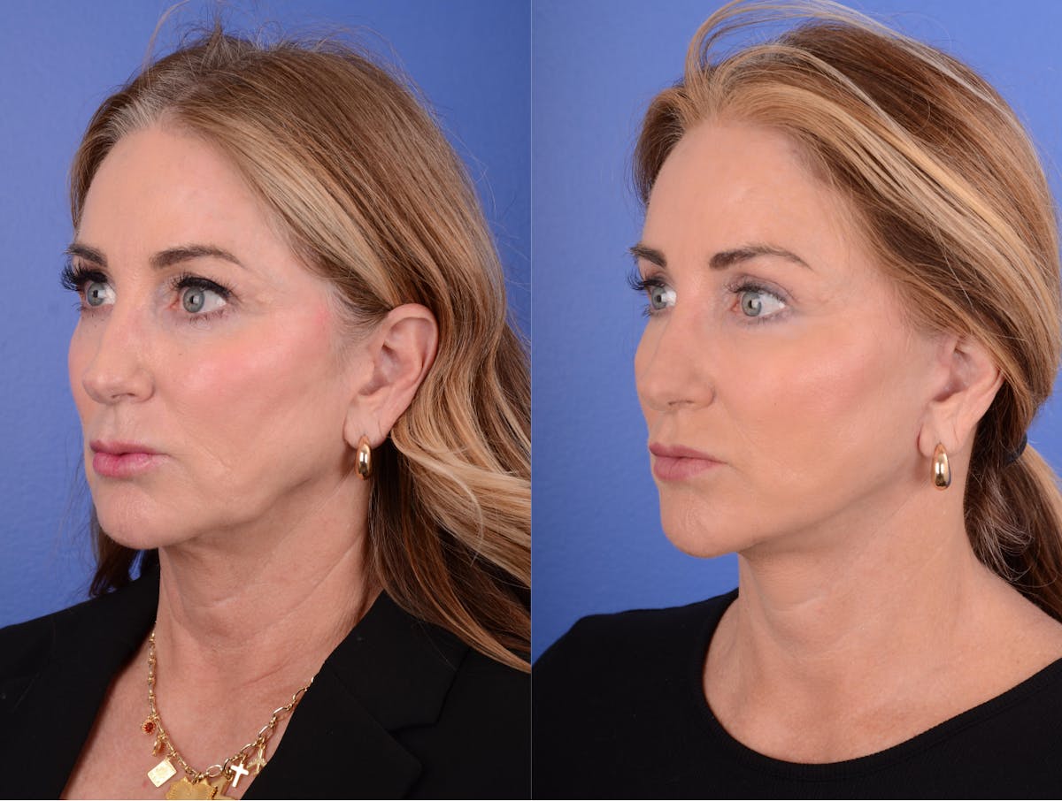 Facelift Before & After Gallery - Patient 169320 - Image 2