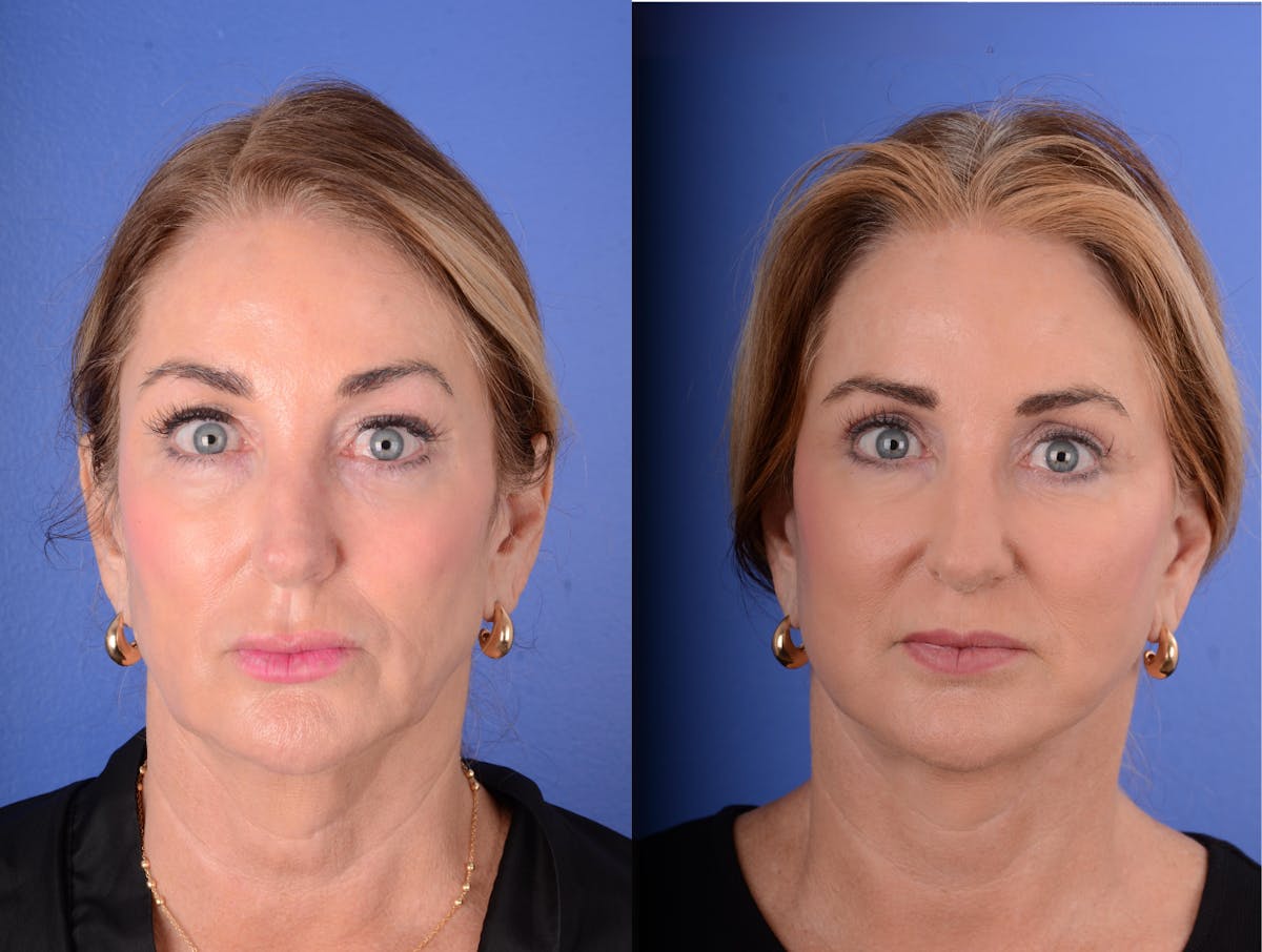 Facelift Before & After Gallery - Patient 169320 - Image 1