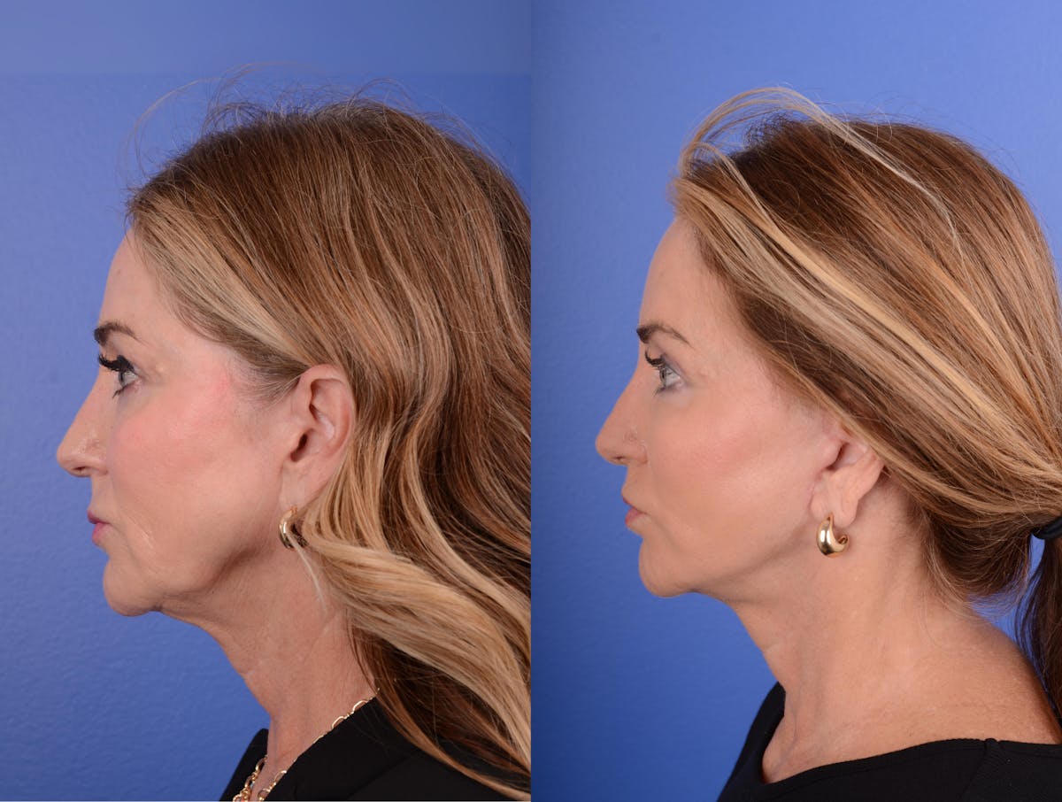 Facelift Before & After Gallery - Patient 169320 - Image 3