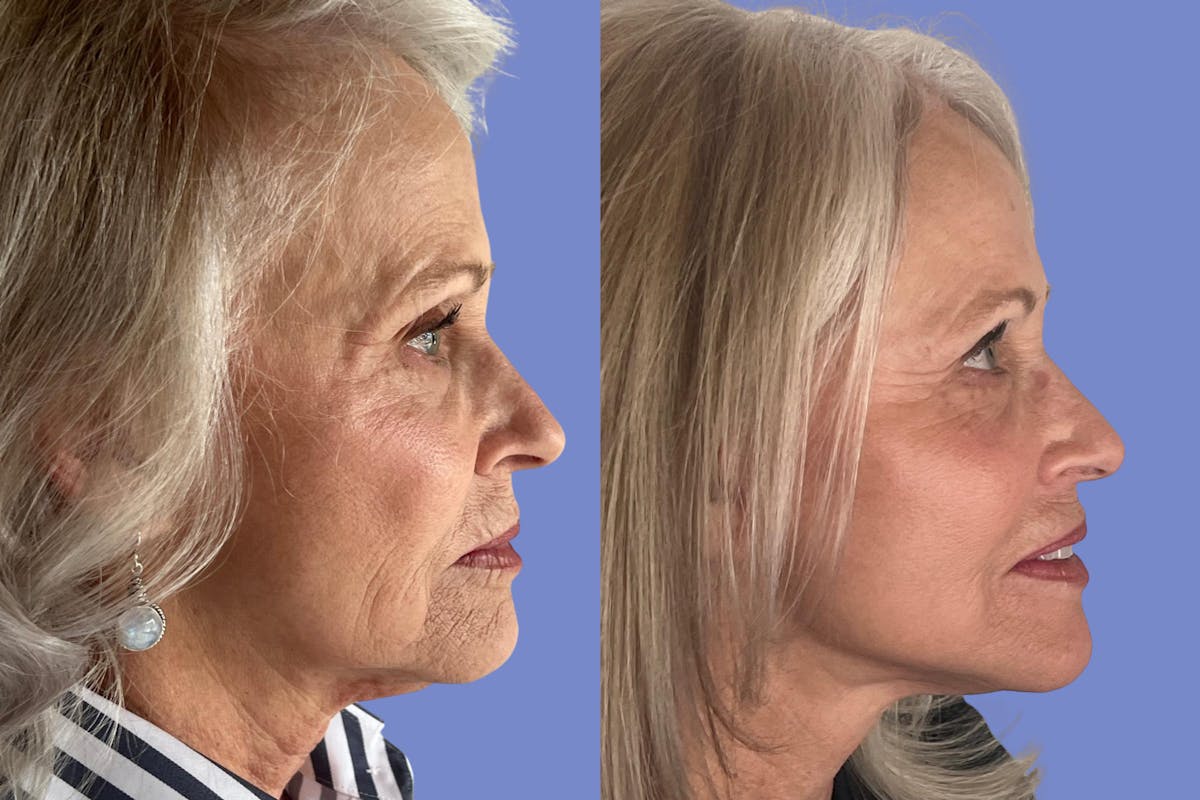 Facelift Before & After Gallery - Patient 560908 - Image 3