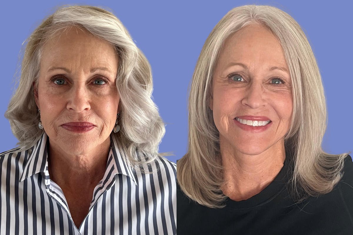 Facelift Before & After Gallery - Patient 560908 - Image 1