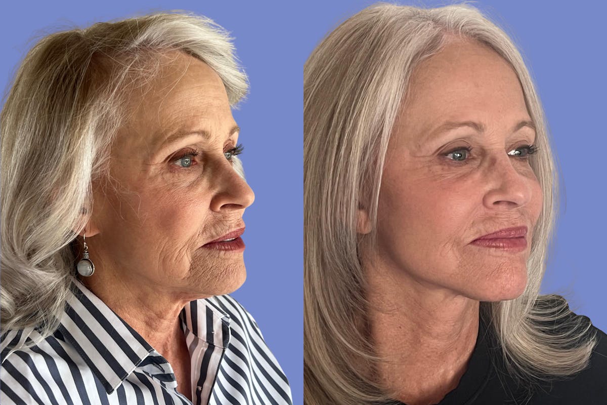 Facelift Before & After Gallery - Patient 560908 - Image 2