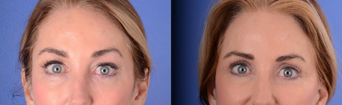 Blepharoplasty Before & After Gallery - Patient 223629 - Image 1