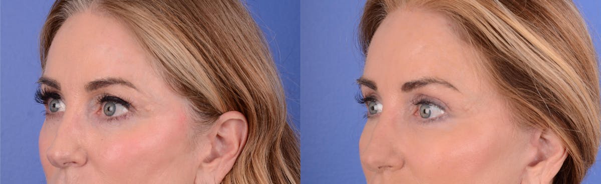 Blepharoplasty Before & After Gallery - Patient 223629 - Image 2