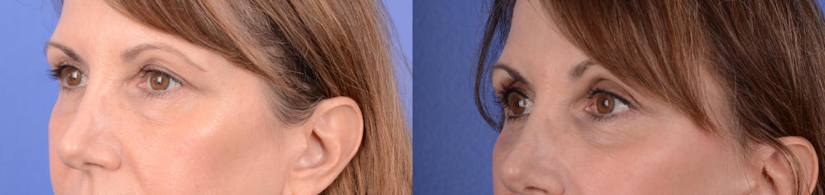 Blepharoplasty Before & After Gallery - Patient 312733 - Image 2