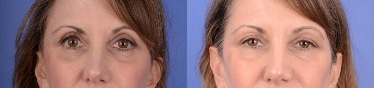 Blepharoplasty Before & After Gallery - Patient 312733 - Image 1