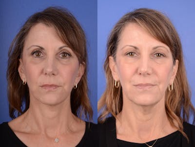Simplicity Neck Lift Before & After Gallery - Patient 117496 - Image 1