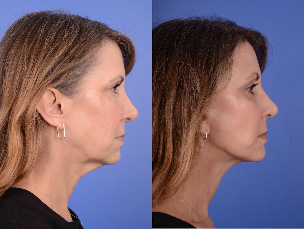 Facelift Before & After Gallery - Patient 383133 - Image 5