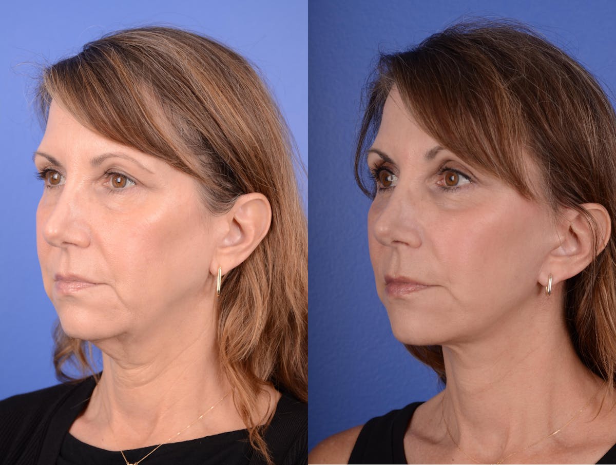 Facelift Before & After Gallery - Patient 383133 - Image 2