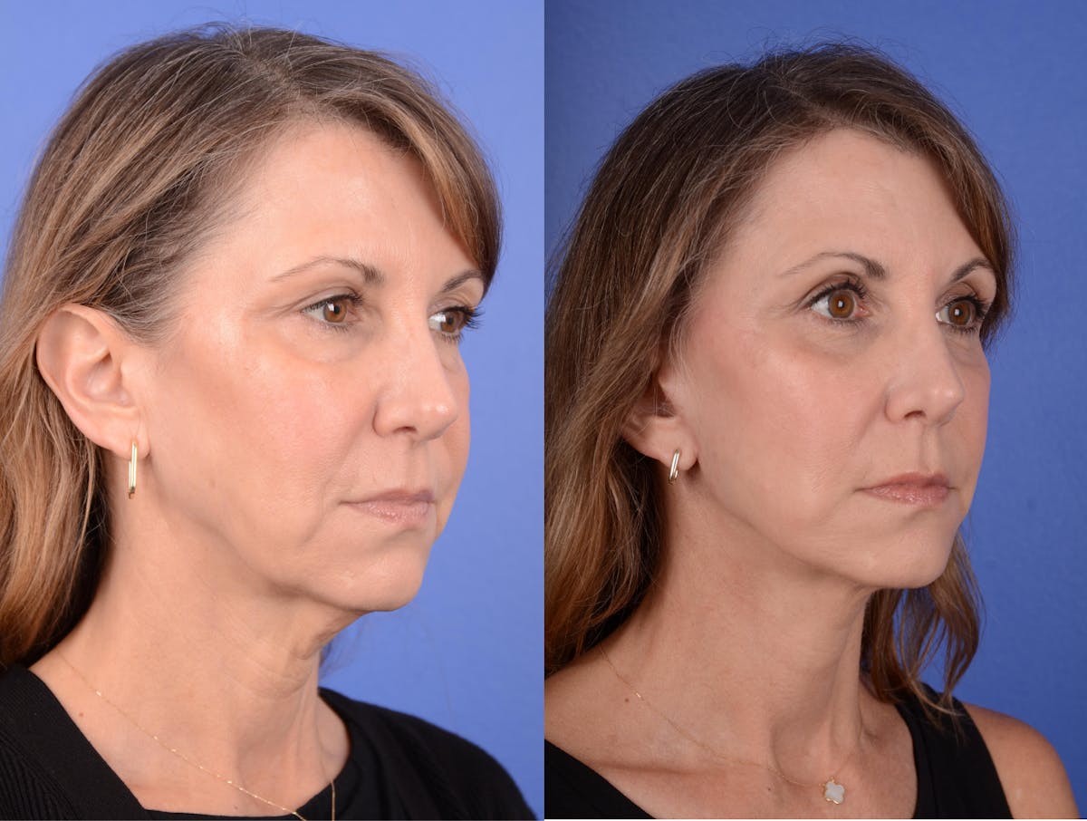 Facelift Before & After Gallery - Patient 383133 - Image 4