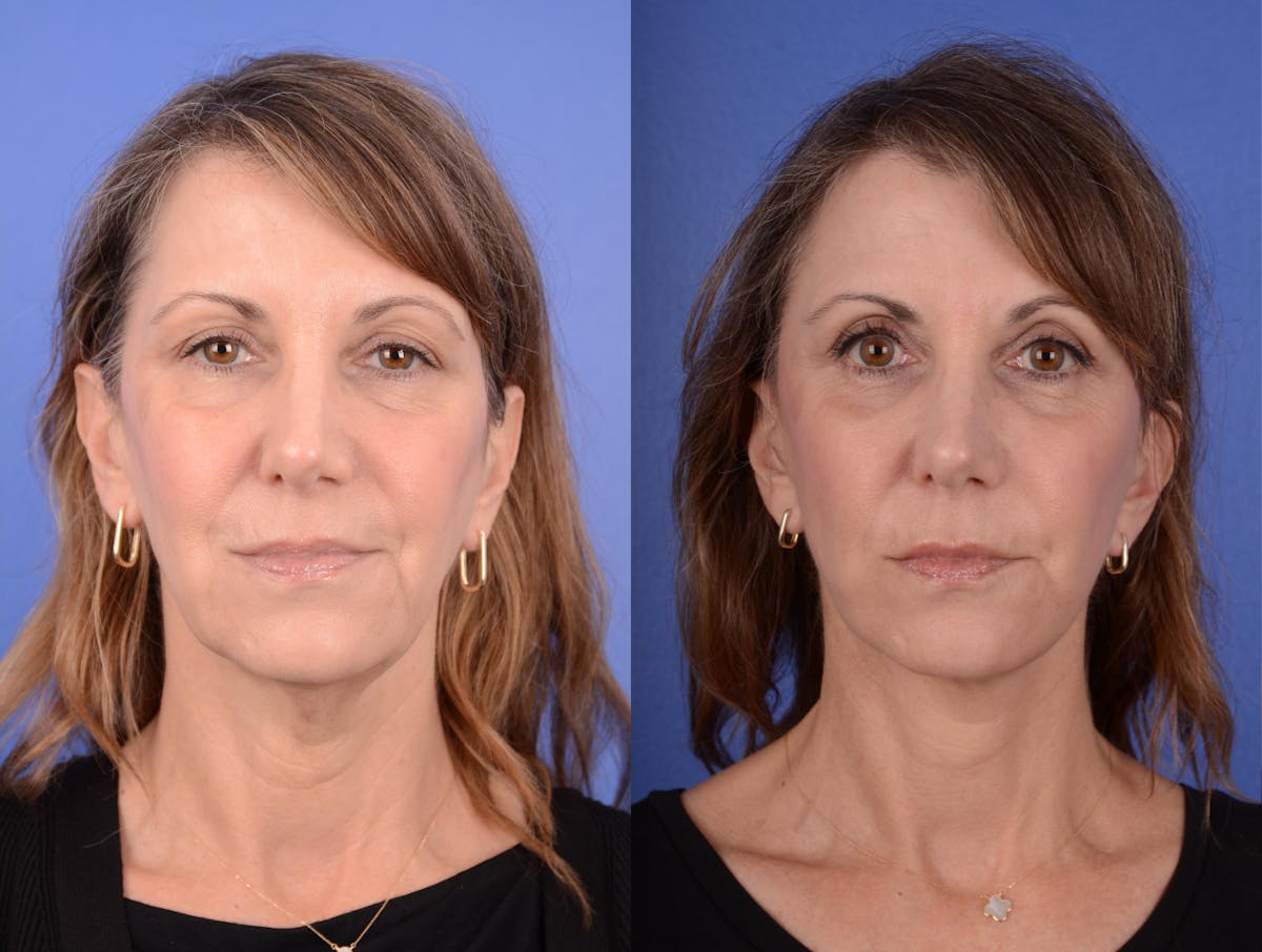 Facelift Before & After Gallery - Patient 218658 - Image 1