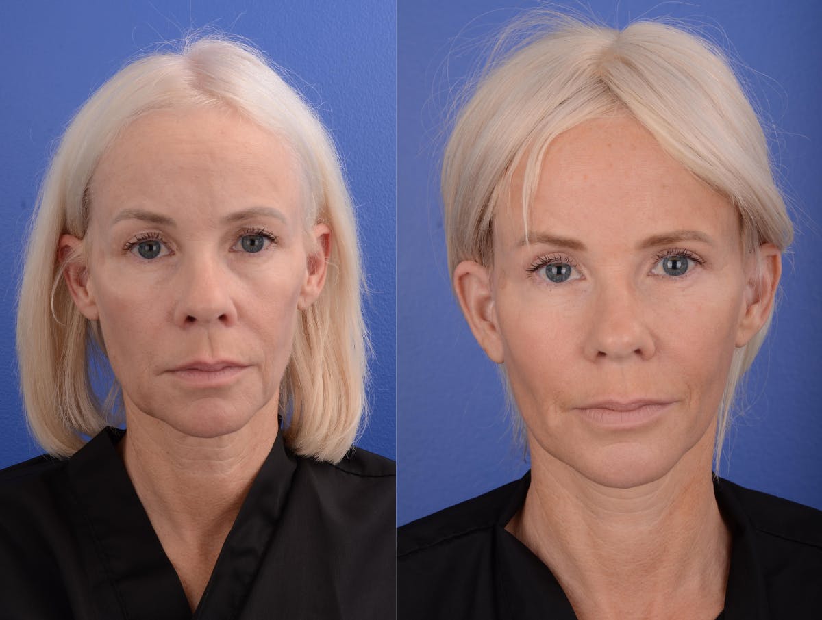 Simplicity Neck Lift Before & After Gallery - Patient 856105 - Image 1
