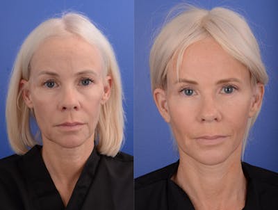 Facial Fat Grafting Before & After Gallery - Patient 151206 - Image 1