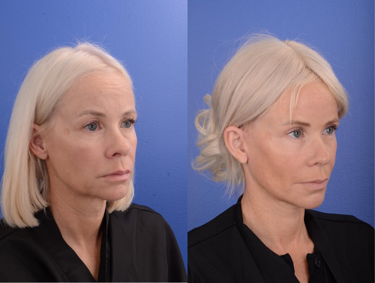Simplicity Neck Lift Before & After Gallery - Patient 856105 - Image 2