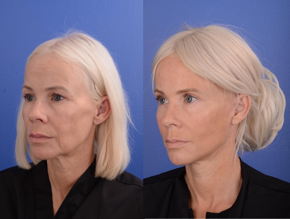 Simplicity Neck Lift Before & After Gallery - Patient 856105 - Image 3