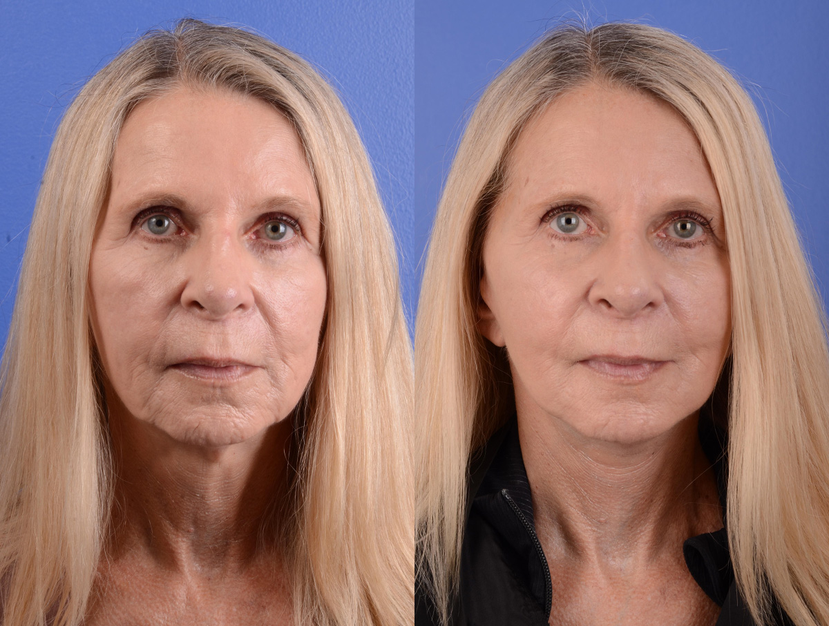 Facelift Before & After Gallery - Patient 398739 - Image 1