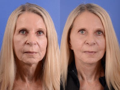 Facelift Before & After Gallery - Patient 398739 - Image 1