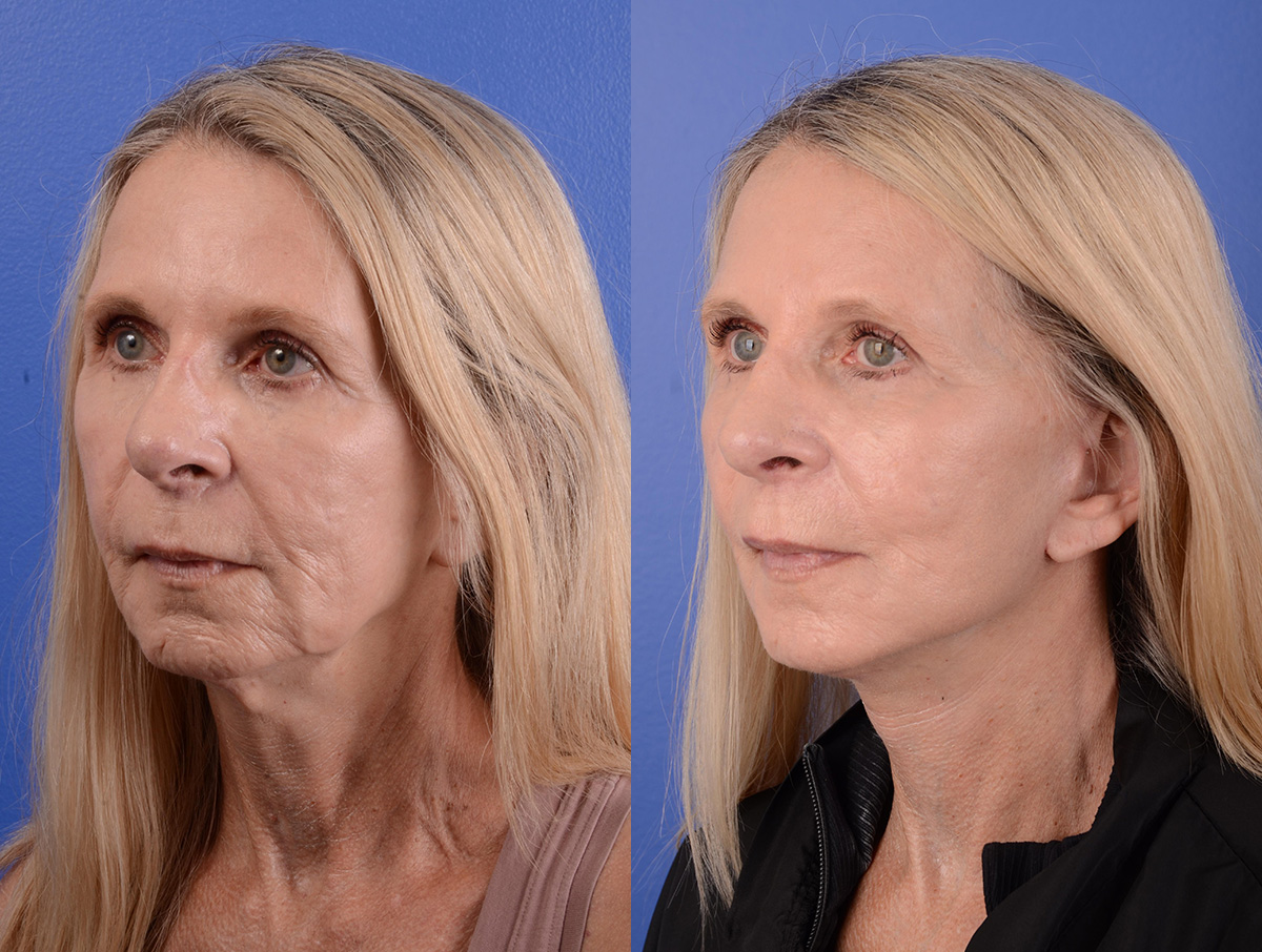 Facelift Before & After Gallery - Patient 398739 - Image 2