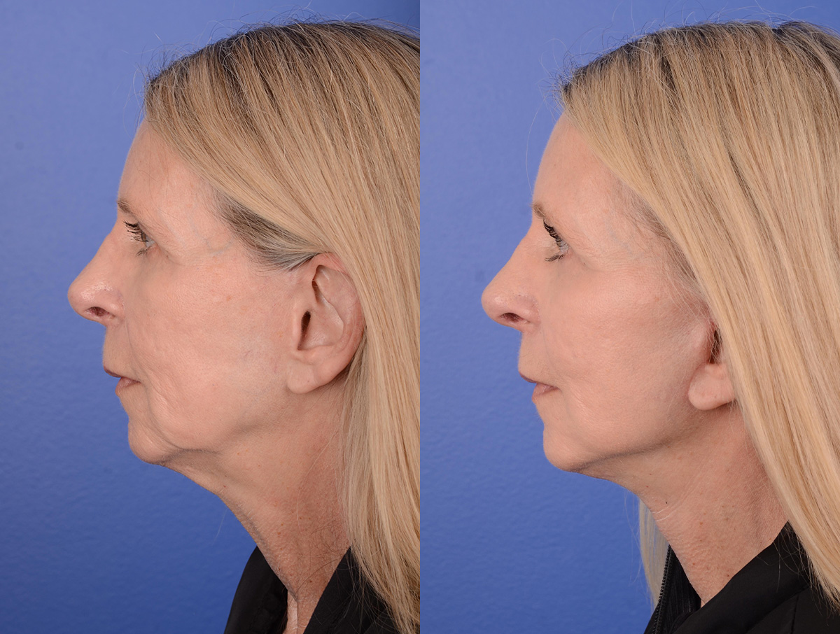 Facelift Before & After Gallery - Patient 398739 - Image 3