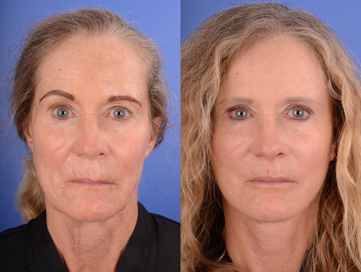 Facelift Before & After Gallery - Patient 282541 - Image 1