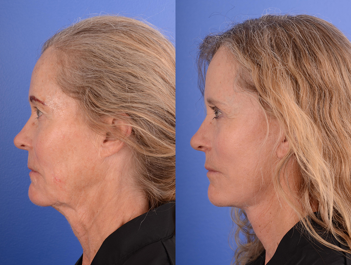 Facelift Before & After Gallery - Patient 282541 - Image 3