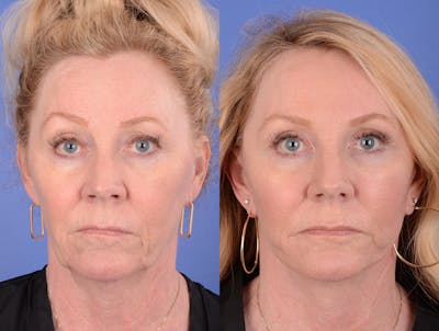 Facelift Before & After Gallery - Patient 184233 - Image 1