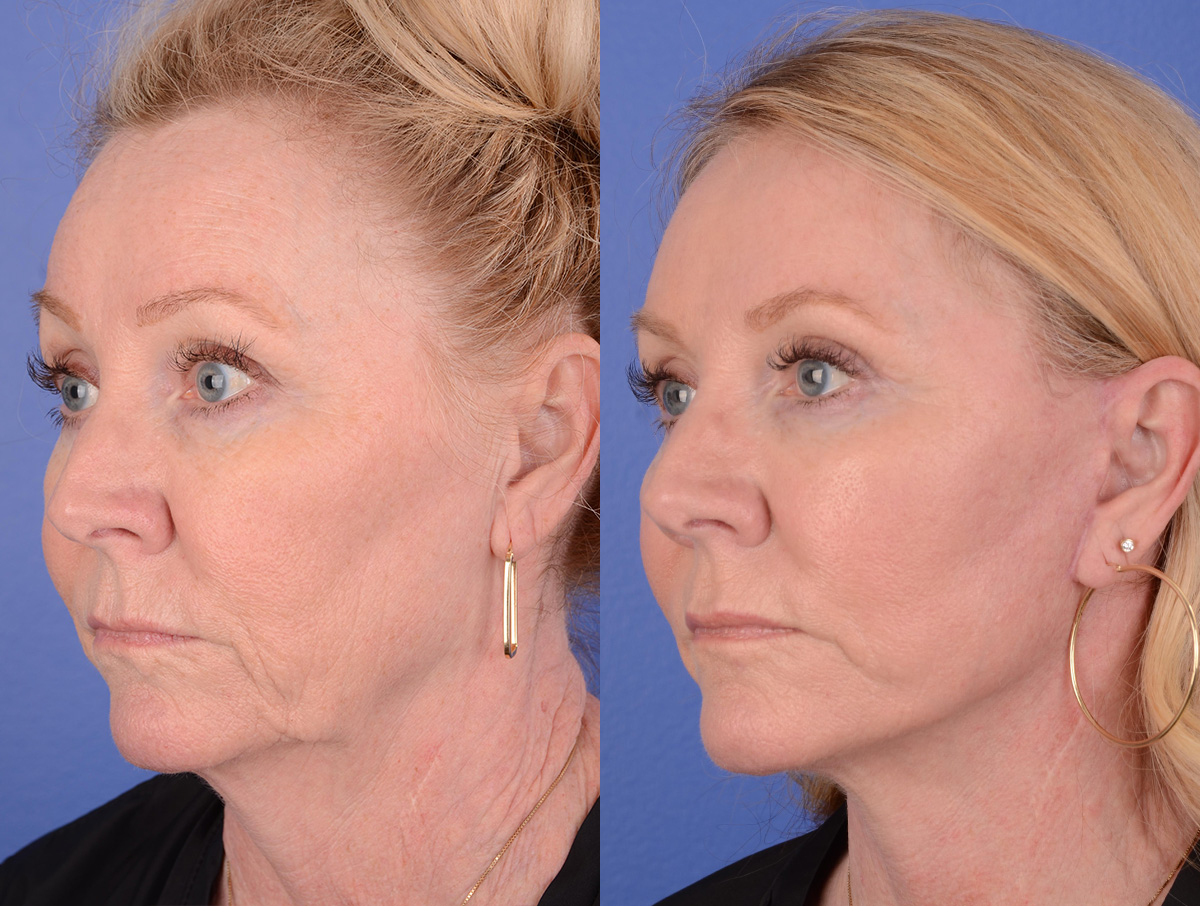 Facelift Before & After Gallery - Patient 184233 - Image 2