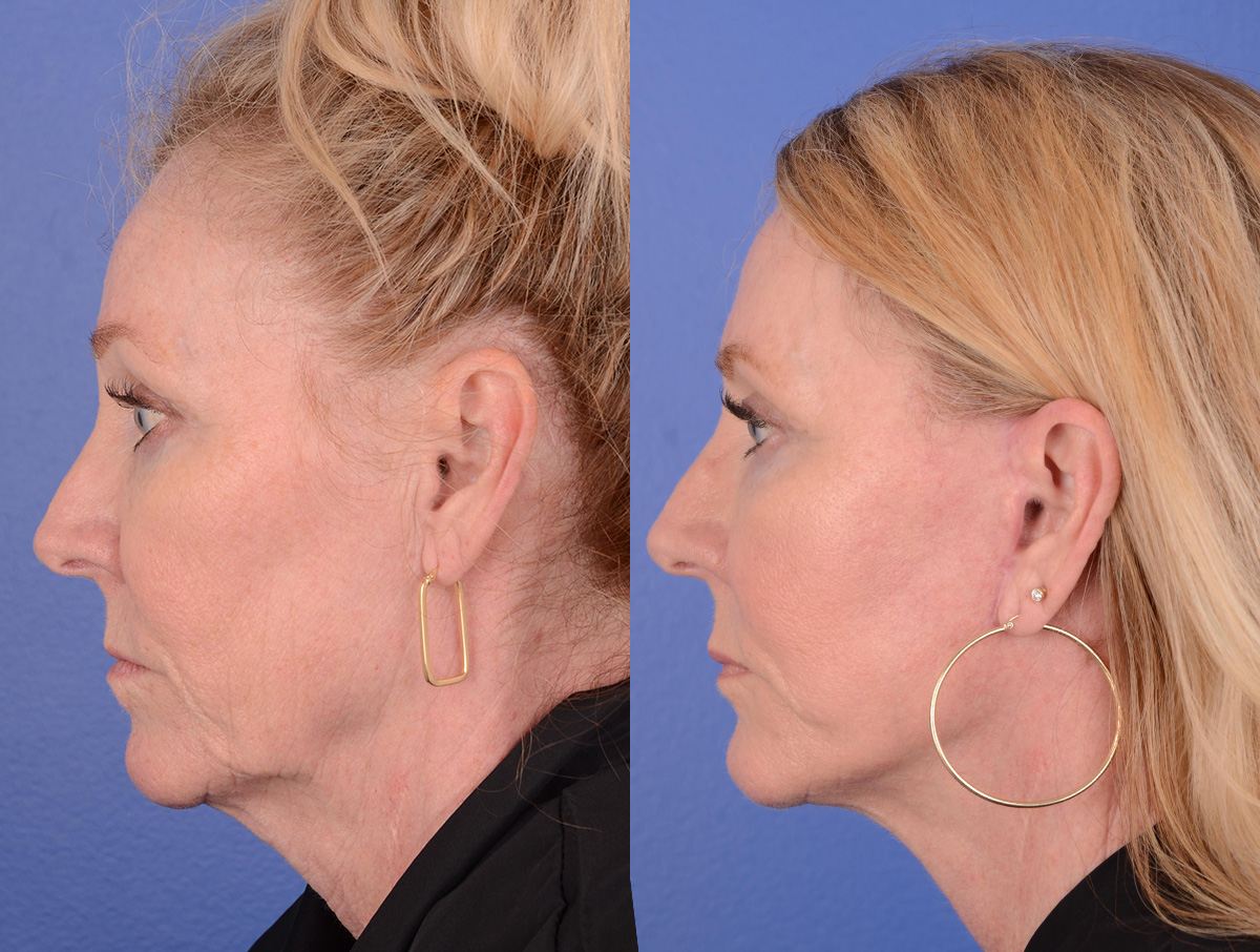Facelift Before & After Gallery - Patient 184233 - Image 3