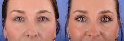 Blepharoplasty Before & After Gallery - Patient 257178 - Image 1
