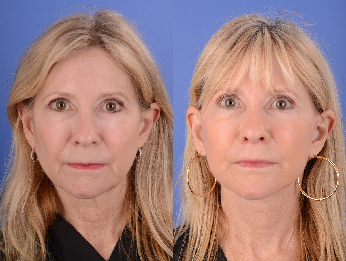 Facelift Before & After Gallery - Patient 144375 - Image 1