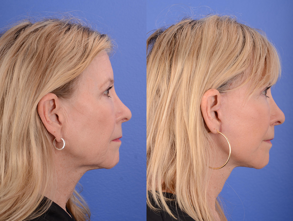 Facelift Before & After Gallery - Patient 144375 - Image 5