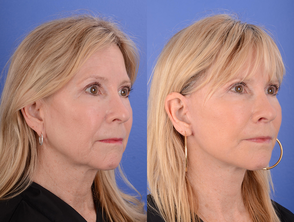 Facelift Before & After Gallery - Patient 144375 - Image 3