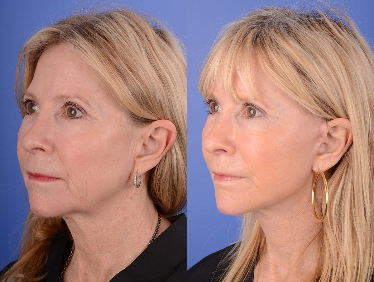 Facelift Before & After Gallery - Patient 144375 - Image 2