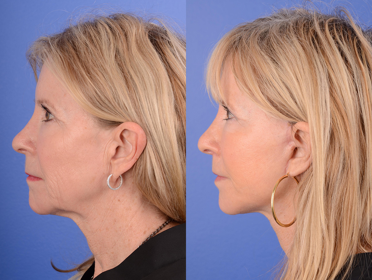 Facelift Before & After Gallery - Patient 144375 - Image 4