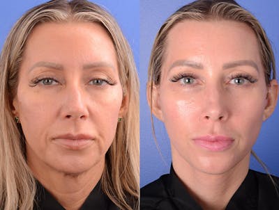 Facelift Before & After Gallery - Patient 116893 - Image 1