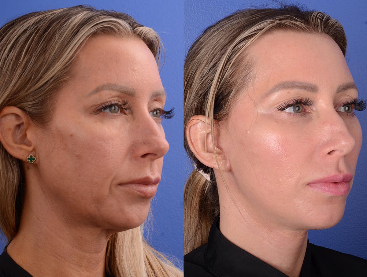 procedure
