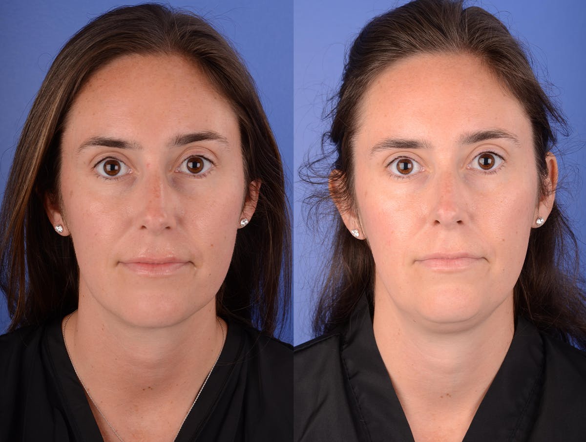Neck Liposuction Before & After Gallery - Patient 216241 - Image 1