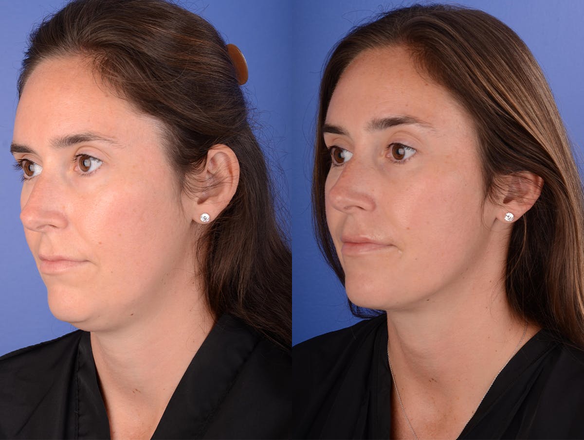 Neck Liposuction Before & After Gallery - Patient 216241 - Image 2