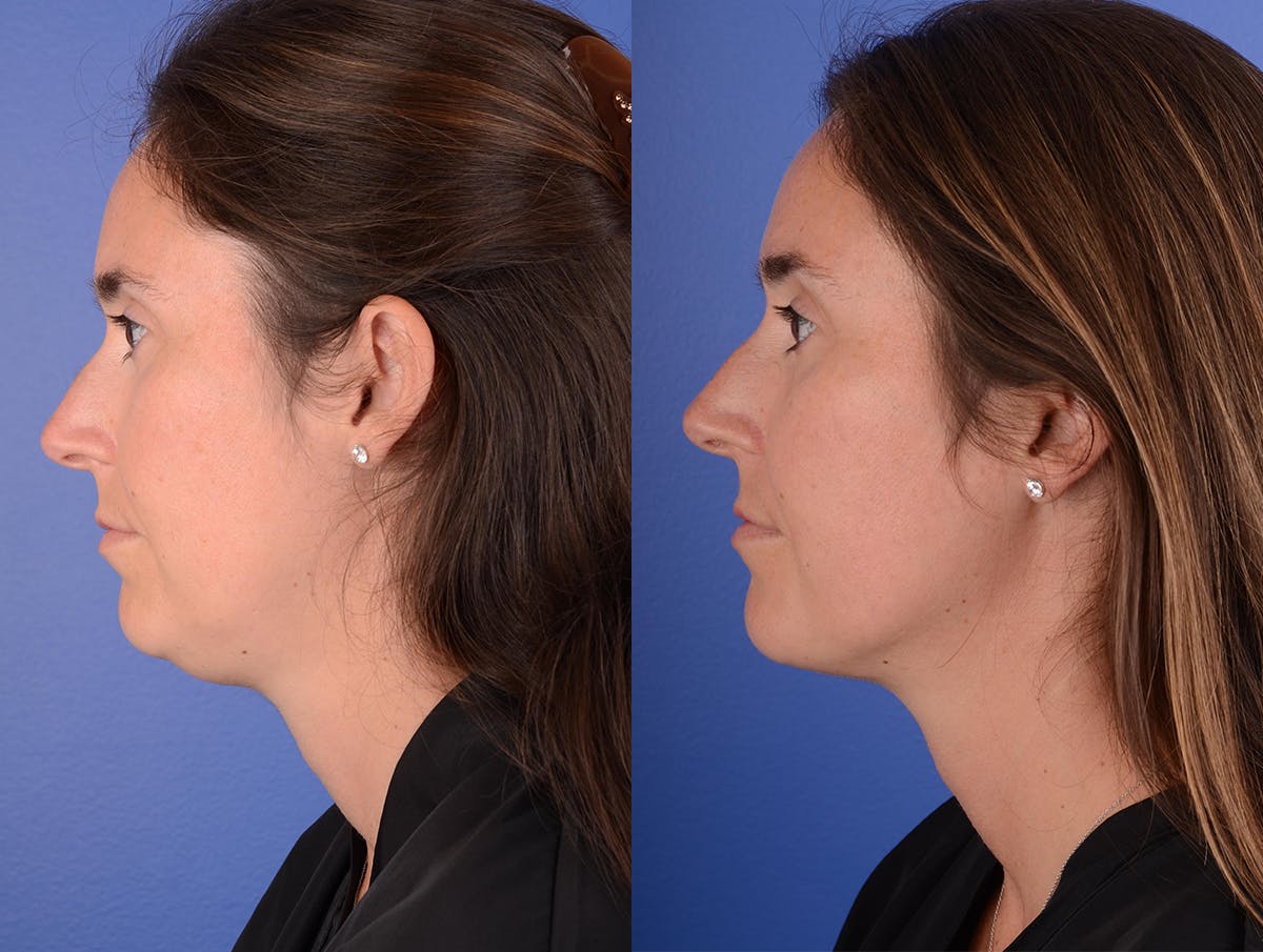Neck Liposuction Before & After Gallery - Patient 216241 - Image 3