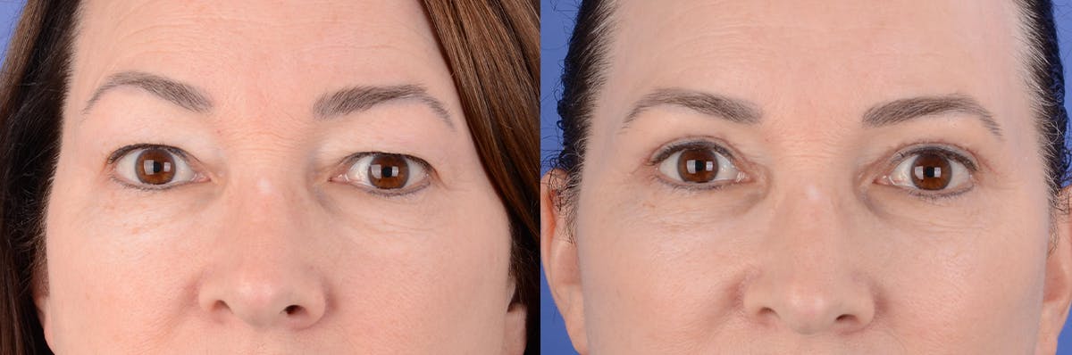 Blepharoplasty Before & After Gallery - Patient 177087 - Image 1