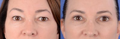 Blepharoplasty Before & After Gallery - Patient 177087 - Image 1
