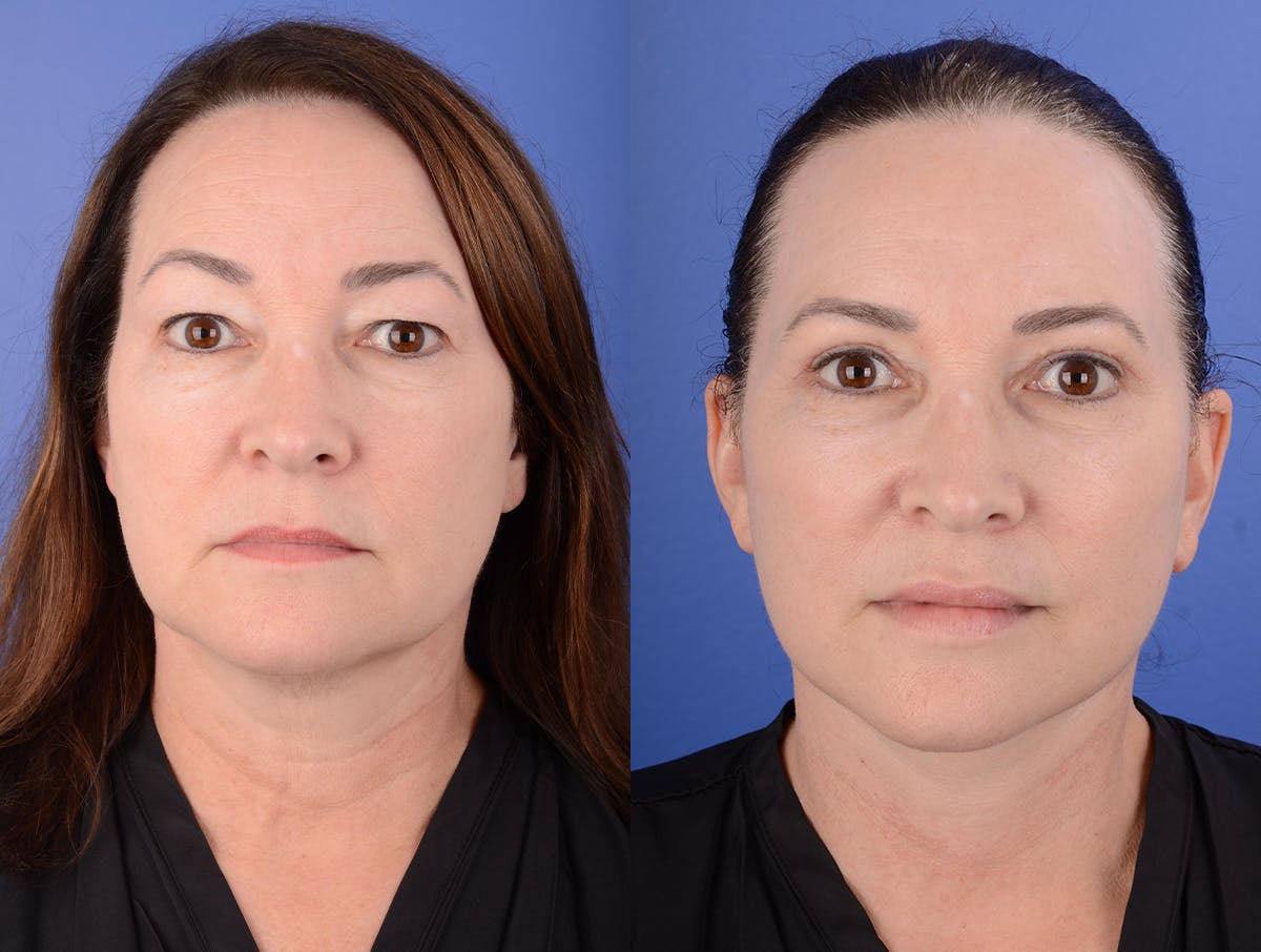 Facelift Before & After Gallery - Patient 341595 - Image 1