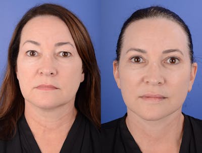 Facial Fat Grafting Before & After Gallery - Patient 328187 - Image 1