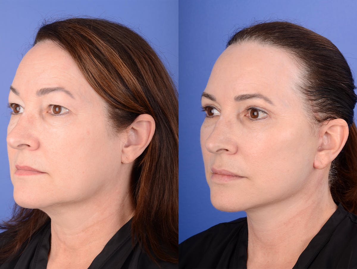Facelift Before & After Gallery - Patient 341595 - Image 2