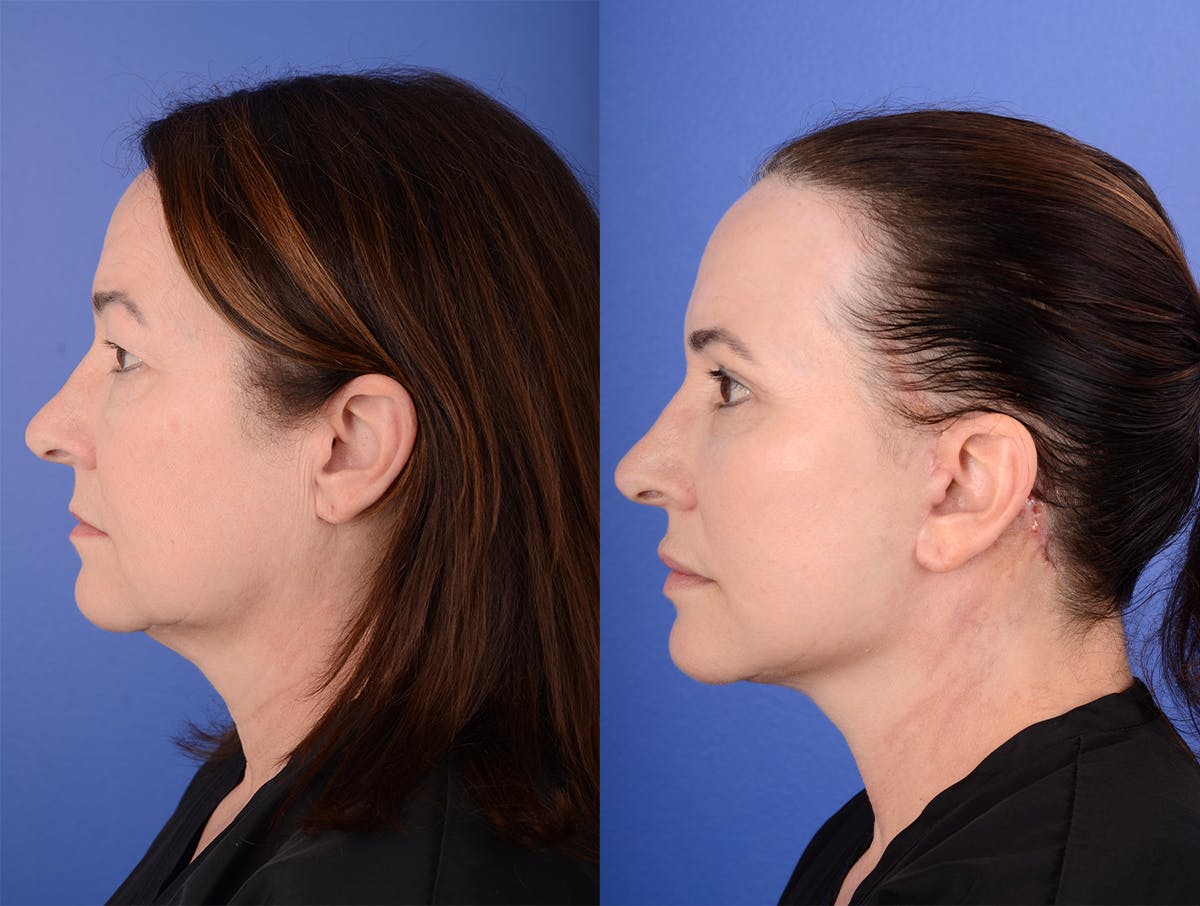 Facelift Before & After Gallery - Patient 341595 - Image 3