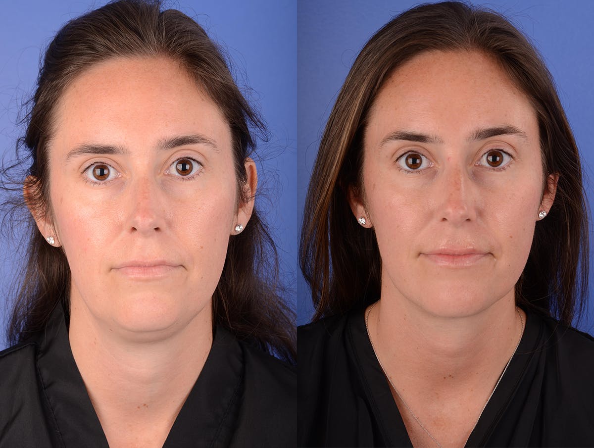 Neck Liposuction Before & After Gallery - Patient 216241 - Image 1