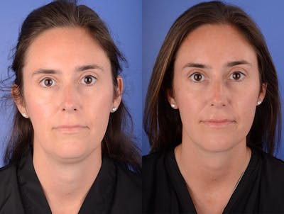 Neck Liposuction Before & After Gallery - Patient 216241 - Image 1