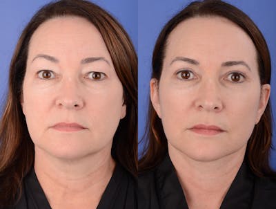 Facelift Before & After Gallery - Patient 341595 - Image 1