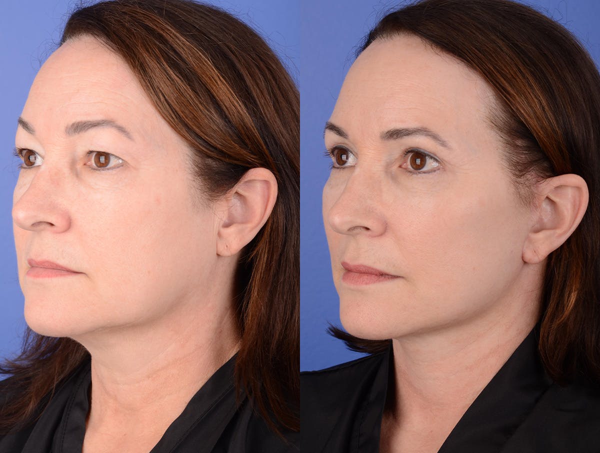 Facelift Before & After Gallery - Patient 341595 - Image 2